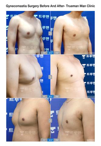 Voor en na gynaecomastie-operatie door de Trueman Man Clinic (foto: Business Wire)