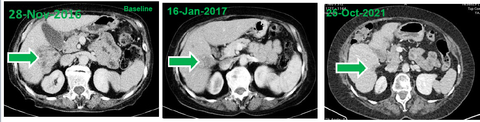 CT images of the tumor at baseline as well as 7 weeks and approximately 5 years after treatment initiation. (Photo: Business Wire)