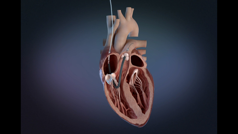 Impella RP Flex with SmartAssist Illustration (Photo: Business Wire)