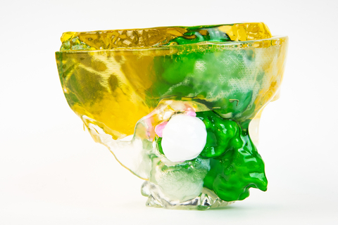 original Patient-specific 3D-printed anatomic model of a large tumor of the right nasal cavity. The patient scan data was prepared for 3D printing using Axial3D's software and then 3D printed by Stratasys. (Photo: Business Wire)