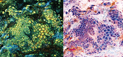 Image shows lung cancer detected using CelTivity™ microscope and virtual stain options. Looking at PET View (left) and Histo View (right) you can see on the right of each image significant cell abnormalities. (Photo: Business Wire)