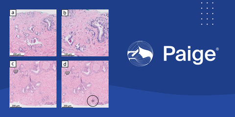 On a whole slide image with an ISUP Group 4 cancer involving 2% of tissue (c), Paige Prostate Detect indicates a focus of interest that is most likely to harbor cancerous tissue (d). The tissue was misclassified as benign by 12 pathologists and deferred by one pathologist. A benign seminal vesicle was misclassified as cancer by five pathologists and deferred by three in the study (a) (b), while Paige Prostate Detect correctly classified the image as benign. Photo: Paige