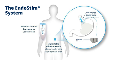 The EndoStim System is designed to provide long-term reflux control by automatically delivering mild electrical signals throughout the day to the patient’s weak or dysfunctional lower esophageal sphincter (LES) muscle, the underlying cause of GERD. (Graphic: Business Wire)