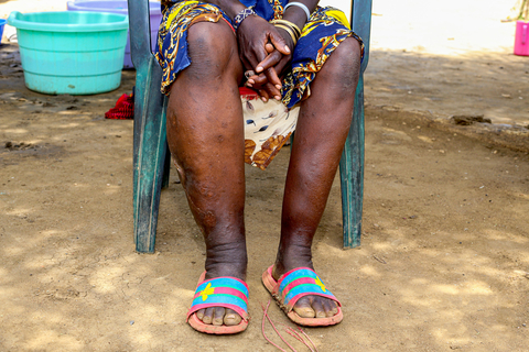 Woman in need of help suffering from elephantiasis (Photo: CBM)