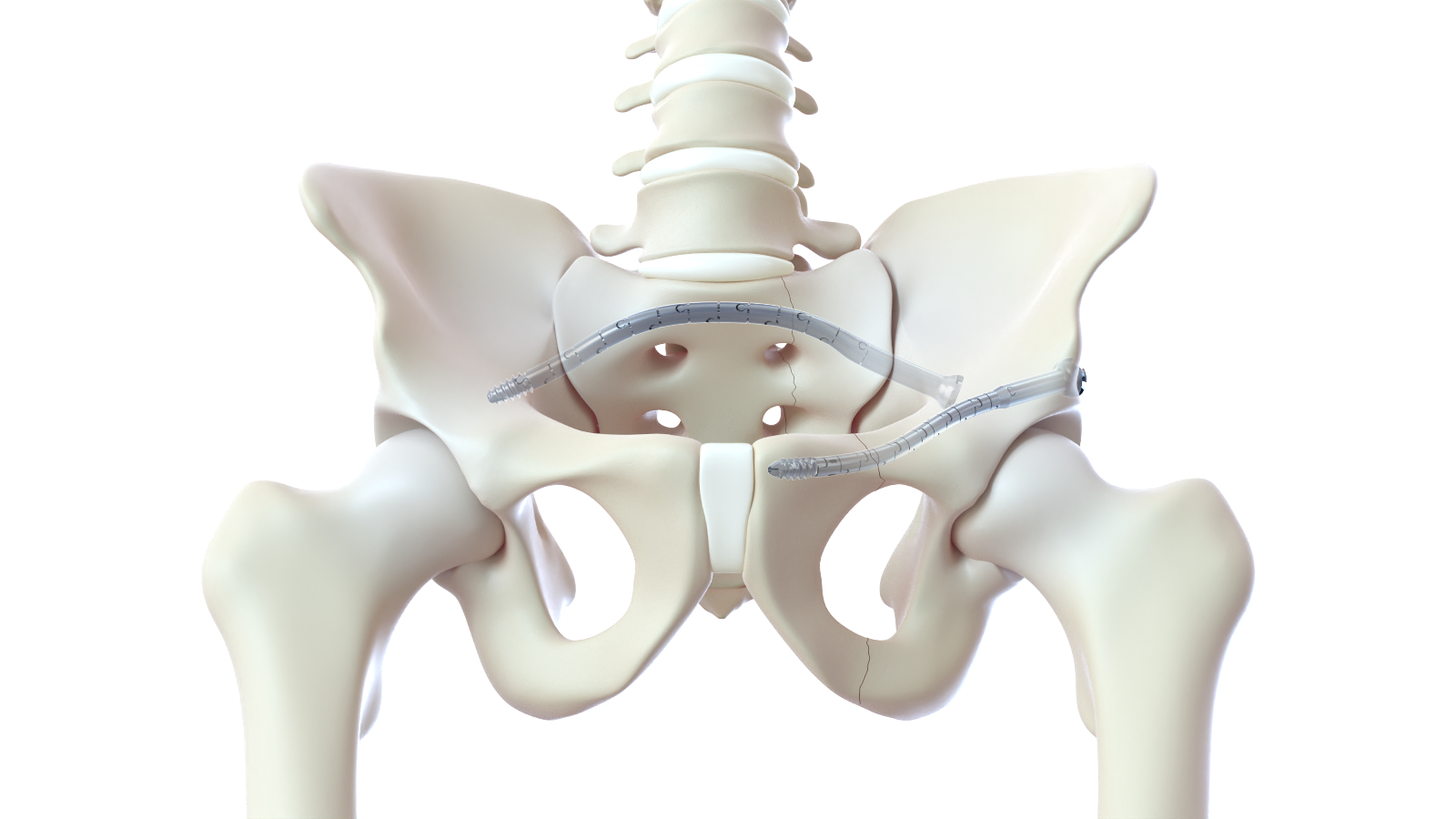 Simplifying The Pelvis