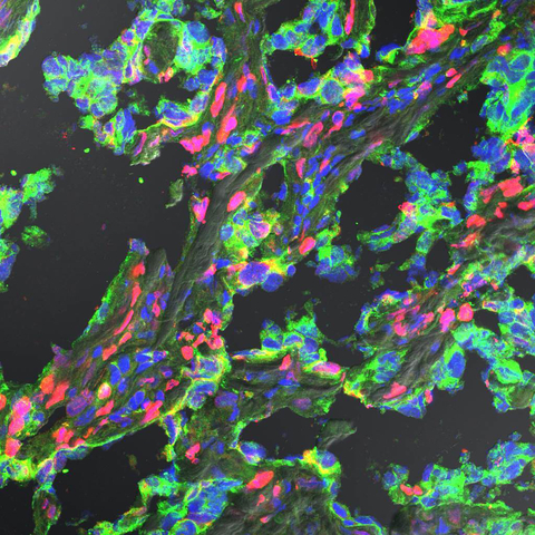 Fig. 2. TNBC47 biomarker (red) stained ductal invasive carcinoma without expressing Her2 (green). (Photo: Business Wire)