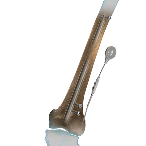 Illustration of the Fitbone™ TAA intramedullary limb-lengthening system, a fully implantable system for correcting leg length and deformity discrepancies. (Photo: Business Wire)