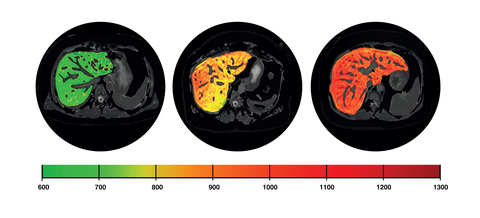 Figure 1. Perspectum’s proprietary AI-powered objective data visualizations of three different livers representing varying degrees of health, starting with a healthy liver (green) on left and ending with a quantitative visualization demonstrating liver inflammation (red orange) on right. (Photo: Business Wire)