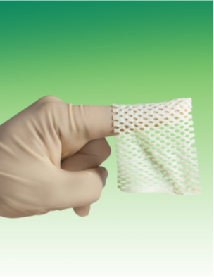AlloPatch® Pliable Meshed is ideal for the treatment of diabetic foot ulcers and venous leg ulcers. Featuring a unique meshed design that allows for optimal drainage and incorporation, it is the only aseptically processed meshed reticular dermal tissue that can be used in both the acute and post-acute settings. The allograft conforms to wound topography for immediate coverage and can expand up to 170% of its original size to accommodate a variety of wound sizes. It provides a scaffold for wound closure that allows a patient’s own cells to proliferate and repopulate the graft to facilitate integration. It also offers structural coverage that supports early re-epithelialization without the need for substantial granulation tissue formation by the host first, which helps to ensure effective healing. (Photo: Business Wire)