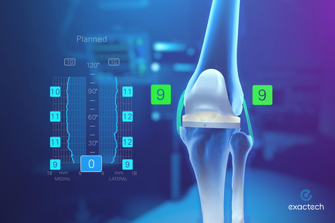 A new Exactech study published in the Journal of Arthroplasty showcases the ability of the Newton™ knee balancing technology to execute dynamic joint balance with a short learning curve. (Photo: Business Wire)