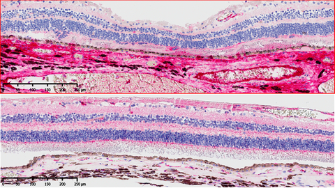 Top: Retina from Diabetic Macular Edema patient (fibrin in bright red); Bottom: Normal Retina; Image credit: Therini Bio