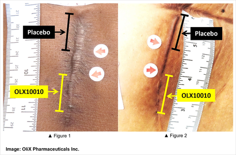 OLX10010 for Hypertrophic Scar Treatment (Image: OliX Pharmaceuticals Inc.)