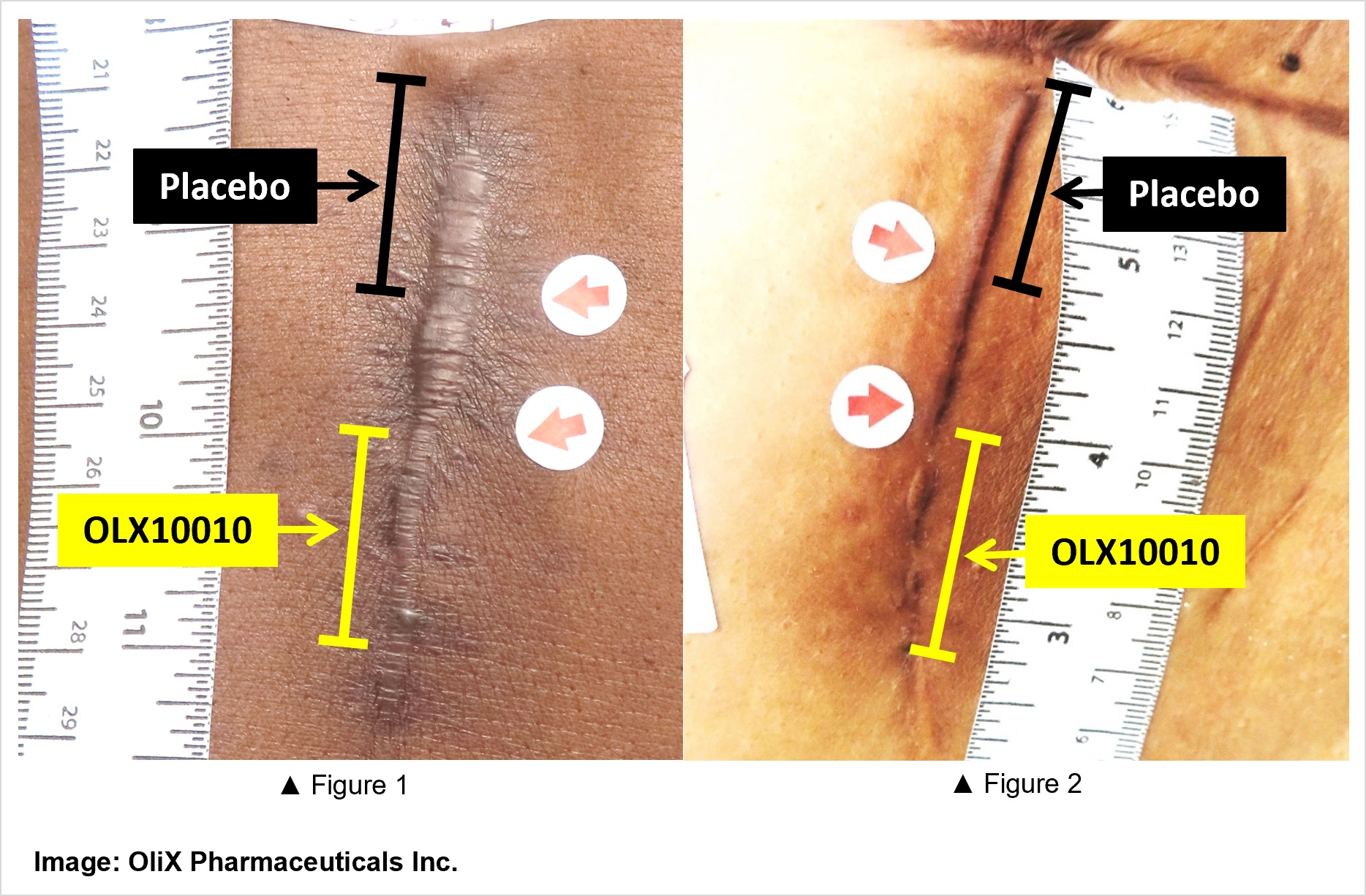 OliX Pharmaceuticals Announces Positive Results from a Phase 2a Trial ...