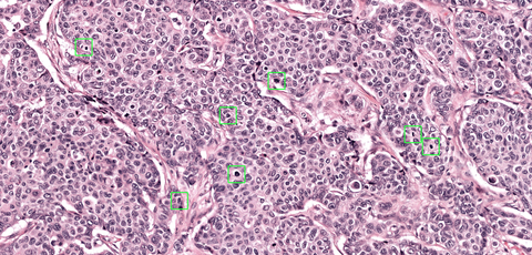 original Mitotic figures (cells that are in the process of dividing) are identified and highlighted with Aiosyn's algorithm for automated mitosis detection. (Photo: Business Wire)