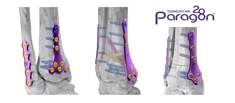 Gorilla® SMO Anterior Dome, Medial Closing Wedge, and Medial Opening Wedge Plating Configurations (Photo: Business Wire)