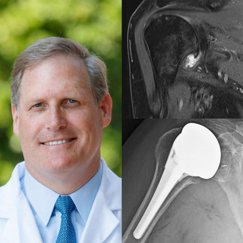 Theodore Blaine, MD, has completed the first series of total shoulder arthroplasty procedures using the Catalyst Stemmed CSR TSA fully convertible system with an ellipsoid humeral head. (Photo: Business Wire)