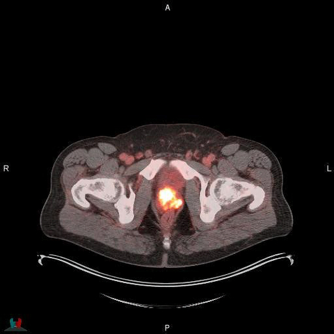 POSLUMA® (flotufolastat F 18) PET/CT image showing uptake in the prostate gland, consistent with primary prostate cancer Photo courtesy of Blue Earth Diagnostics