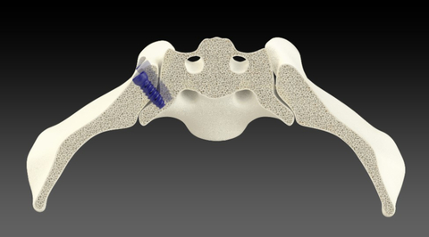 Posterior Oblique Approach (Photo: Business Wire)