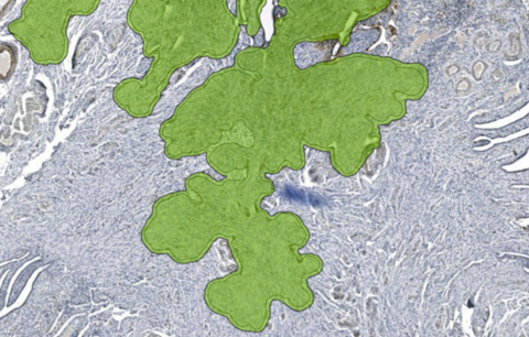 Unreadable regions affected by air bubbles on an IHC stained slide image are identified and highlighted with Aiosyn's automated quality control solution powered by AI. (Graph: Business Wire)