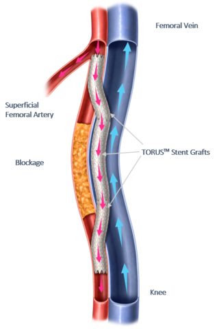 Percutaneous Transmural Arterial Bypass (PTAB) using the DETOUR System. (Graphic: Business Wire)