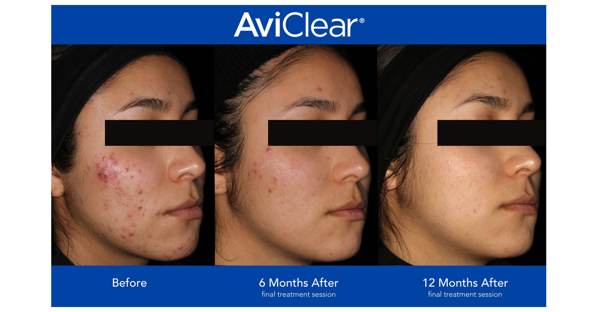 Picture of FDA Clears AviClear® as a Long-Term Treatment for Mild to Severe Acne ...