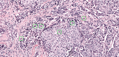 Cells undergoing division, also named mitotic figures or mitoses, are identified and highlighted with Aiosyn's algorithm for automated mitosis detection. (Photo: Business Wire)