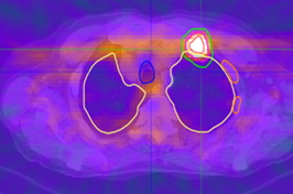 The prostate-specific PET radiotracer, 18F-DCFPyL, signals avid bone metastasis in a patient with prostate cancer. (Image courtesy of City of Hope)