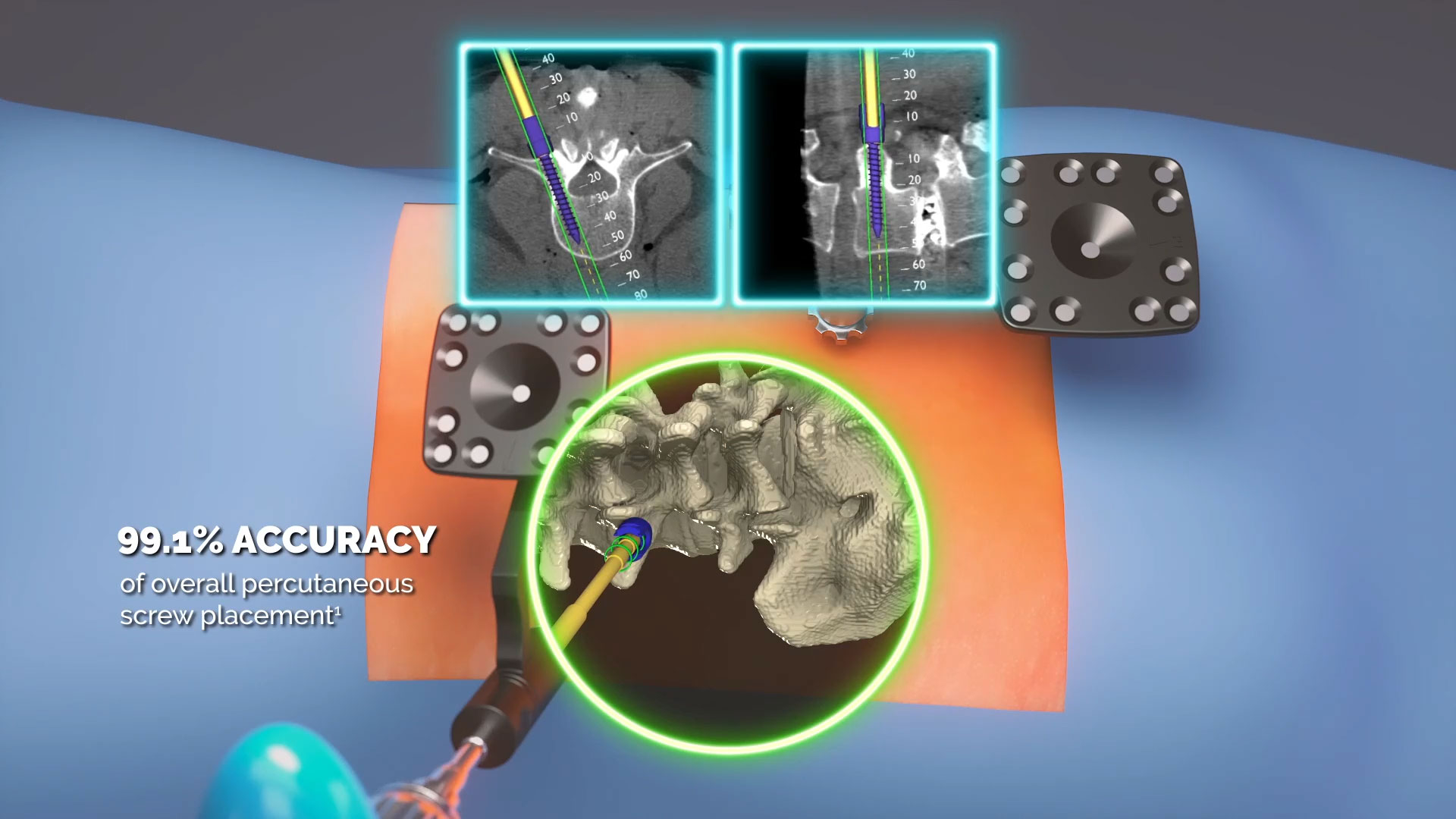 Watch: xvision gives surgeons the power to see patients' anatomy as if they have "x-ray vision,” and accurately navigate instruments and implants during spine surgery. Video: Augmedics