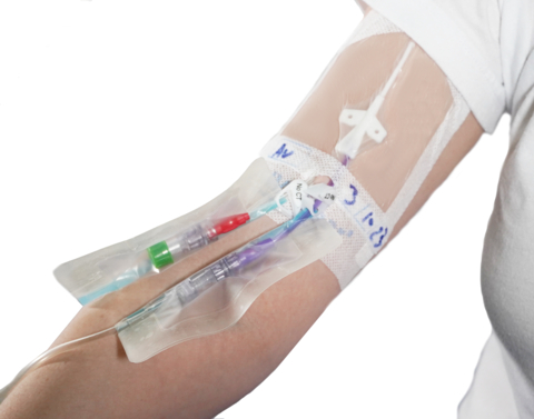 IV fluid line secured to the forearm with IV Clear®, a soft dual-antimicrobial silicone IV securement dressing offered by Covalon. (Photo: Business Wire)