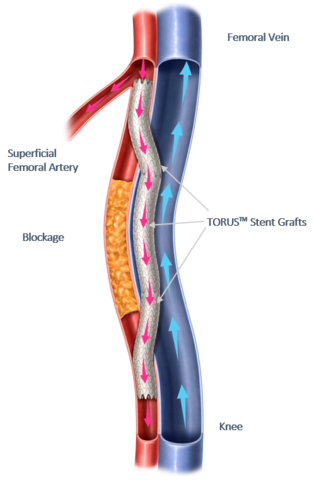 Percutaneous Transmural Arterial Bypass (PTAB) using the DETOUR System (Graphic: Business Wire)