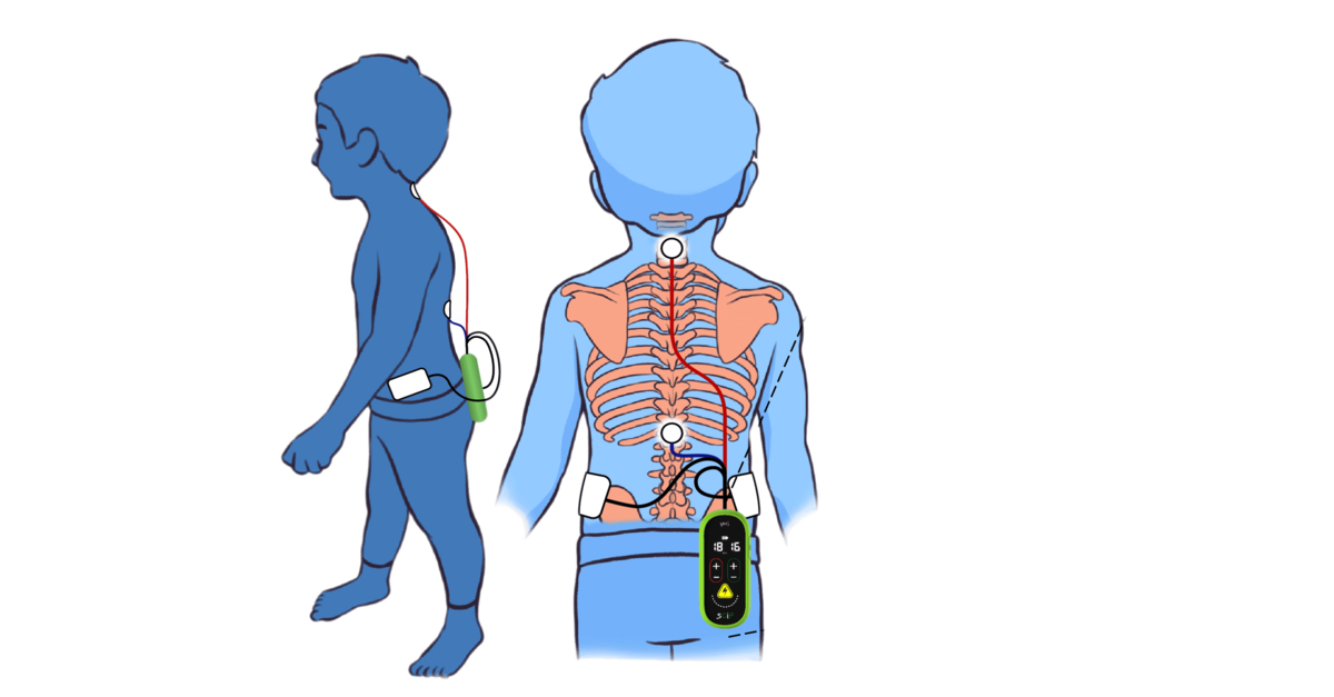 Leading MedTech Company SpineX Releases Groundbreaking Results of New Cerebral Palsy Therapies