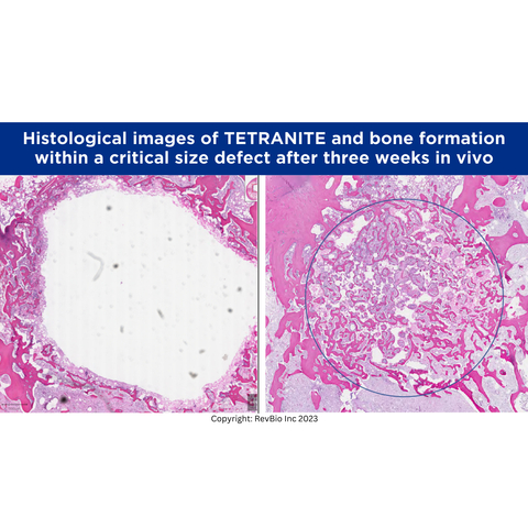 Above are histological images of bone formation within a critical size defect after three weeks in vivo in a rabbit distal femur. On the left, the original Tetranite formulation shows very little substitution with new bone and appears white, which indicates the presence of the biomaterial. On the right, the more osteopromotive formulation shows significant bone in-growth with the red and pink areas indicating new bone substituting the Tetranite biomaterial. (Photo: Business Wire)