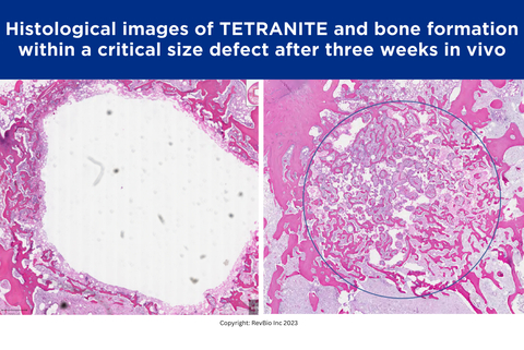 Above are histological images of bone formation within a critical size defect after three weeks in vivo in a rabbit distal femur. On the left, the original Tetranite formulation shows very little substitution with new bone and appears white, which indicates the presence of the biomaterial. On the right, the more osteopromotive formulation shows significant bone in-growth with the red and pink areas indicating new bone substituting the Tetranite biomaterial. (Photo: Business Wire)