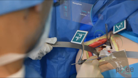 thumbnail Shoulder+, navigation 3D précise des instruments chirurgicaux.
crédit : Pixee Medical