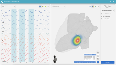 With advanced visualization and automation features, vMap empowers physicians to accurately identify the source location of cardiac arrhythmias. (Graphic: Business Wire)