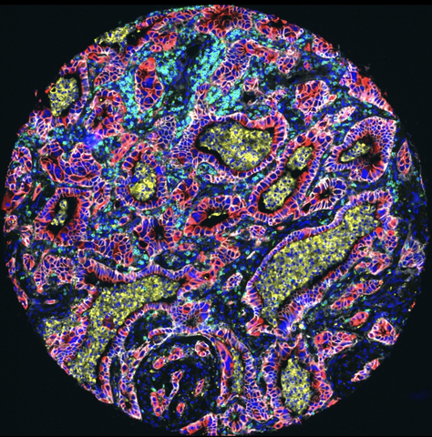 Human lung cancer specimen demonstrating tumor and immune interactions with a subset of Noetik protein panel. (Graphic: Business Wire)