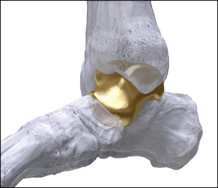 Paragon 28’s first in the world 3D-printed Patient Specific Talus Spacer. Use in treatment of avascular necrosis (AVN). FDA approval: February 17, 2021 through an approval order for a Humanitarian Device Exception (“HDE”). (Graphic: Business Wire)