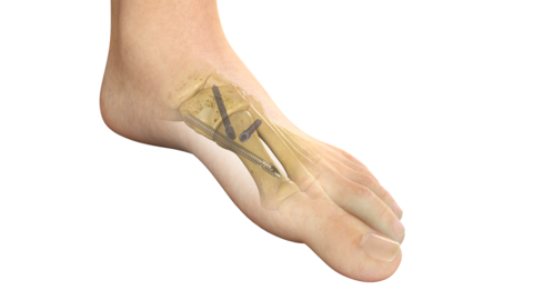 Stryker's PROstep® MIS Lapidus is a new internal fixation system intended for treating bunions using a minimally invasive surgical reduction of hallux valgus deformity and subsequent fusion of the first metatarsal cuneiform joint. (Graphic: Business Wire)