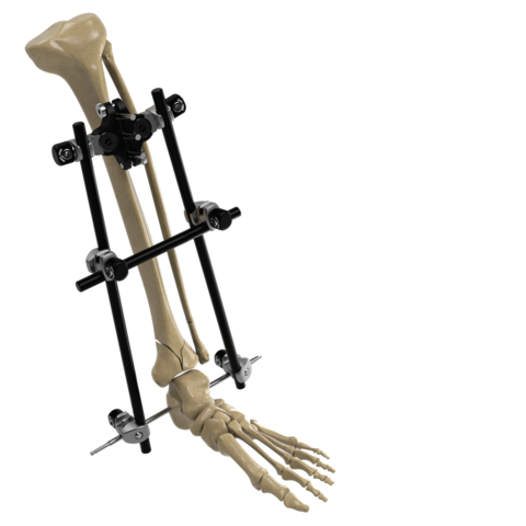 Image of the Galaxy Fixation Gemini System for treating fractures that result from trauma in the lower and upper limbs. (Photo: Business Wire)