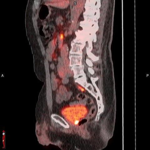 original POSLUMA® (flotufolastat F 18) PET/CT image showing uptake in the prostate bed, consistent with recurrent prostate cancer Photo courtesy of Blue Earth Diagnostics