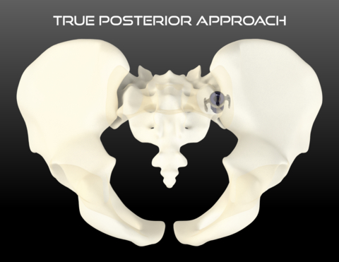 True Posterior Approach (Photo: Business Wire)
