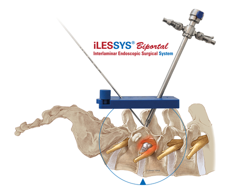 joimax® Launches New iLESSYS® Biportal Interlaminar Endoscopic Surgical System (Photo: Business Wire)