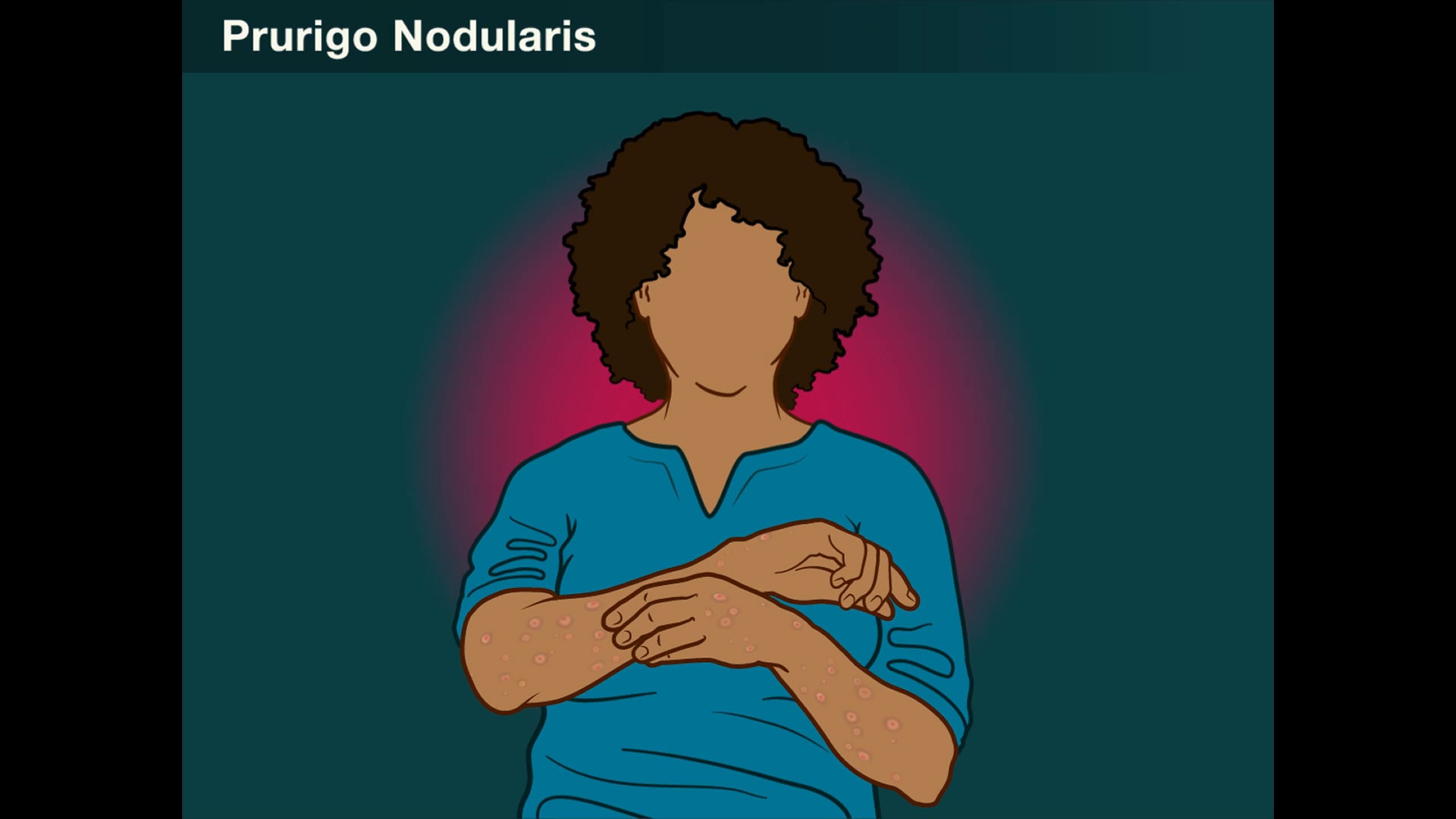 Prurigo nodularis is a chronic, debilitating skin disease characterized by severe itching and widespread nodular lesions. Nemolizumab is under study as a potential treatment option. New research findings are summarized in a short video.