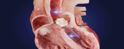 original Xenter introduced at TCT the first-of-its-kind wireless guidewire designed for use during transcatheter aortic valve replacement (TAVR) procedures that aims to collect an extensive range of crucial real-time data points to serve as an aortic regurgitation measurement (xAR™) and clinical decision support tool, significantly enhancing the prediction of para valvular leak (PVL) during TAVR. (Photo: Business Wire)