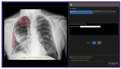 On-device, CCS2.1 output from GE HealthCare's AMX Navigate mobile X-ray system showing PTX overlay and confidence level. (Photo: GE HealthCare)