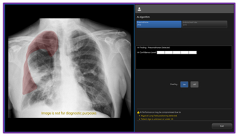 original On-device, CCS2.1 output from GE HealthCare's AMX Navigate mobile X-ray system showing PTX overlay and confidence level. (Photo: GE HealthCare)