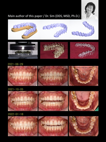 « Orthodontic Treatments Using Directly 3D-Printed Clear Aligners », publié dans le Journal of Clinical Orthodontics en octobre 2023 (Illustration : Business Wire)