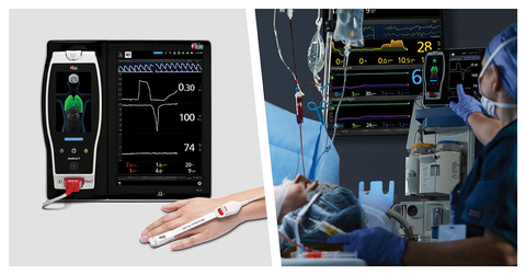 New Study Finds Significant Correlation Between Masimo ORi™ and Arterial Partial Pressure of Oxygen During One-Lung Ventilation