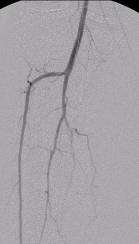 Figure 1. Calf angiogram obtained using the Summa Finesse catheter with 1 ml equivalent of 60% contrast. (Photo: Business Wire)