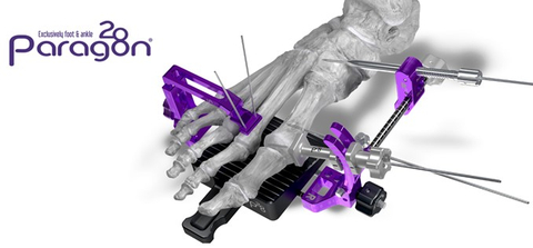 Figure 1: Paragon 28 Bun-Yo-Matic™ Lapidus Clamp System (Graphic: Paragon 28)